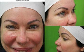 Eyebrow Transplants Post Procedure