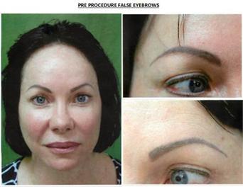 Eyebrow Transplants before procedure